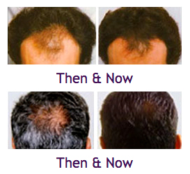 Laser Comb Vivandi One Stop Solutions For Hair Loss In Dubai