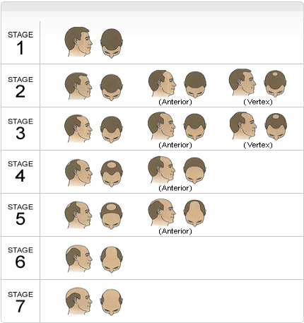 Norwood Hair Loss Chart