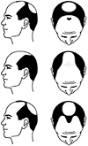Hair-Loss-in-Man