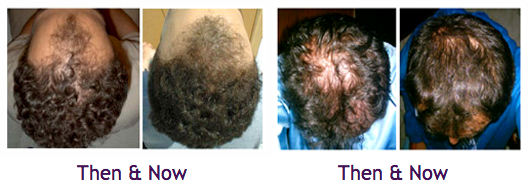Laser-Hair-Loss-Therapy-before-after
