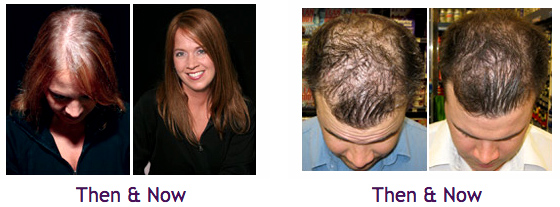 Tricomax-Laser-Hair-Therapy_before-after