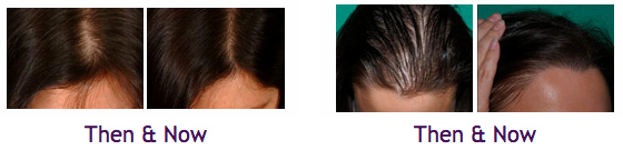 Tricomax-Laser-Hair-Therapy_before-after-Dubai