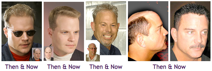 hair_replacement